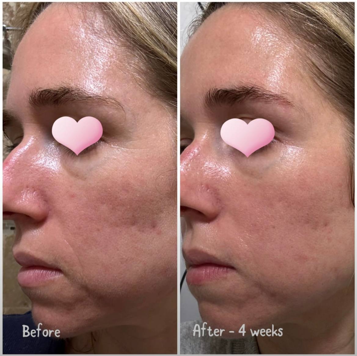 LUMISKIN™ LED Light Therapy Face Mask