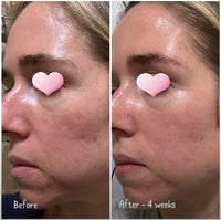 LUMISKIN™ LED Light Therapy Face Mask